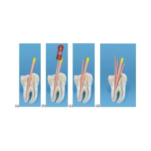 Root Canal